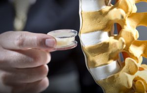 mezhpozvonochnyie-diski-na-3d-printere